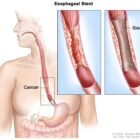 Oesophageal Cancer Surgeon in Dehradun – Expert Care by Dr. Sachin Arora