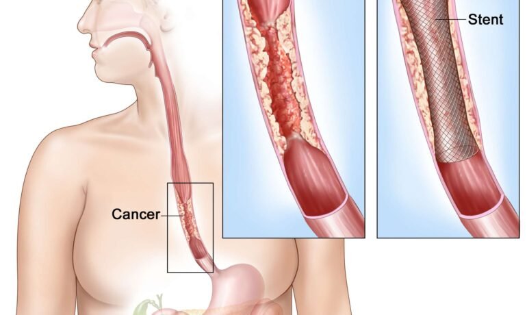 Oesophageal Cancer Surgeon in Dehradun – Expert Care by Dr. Sachin Arora