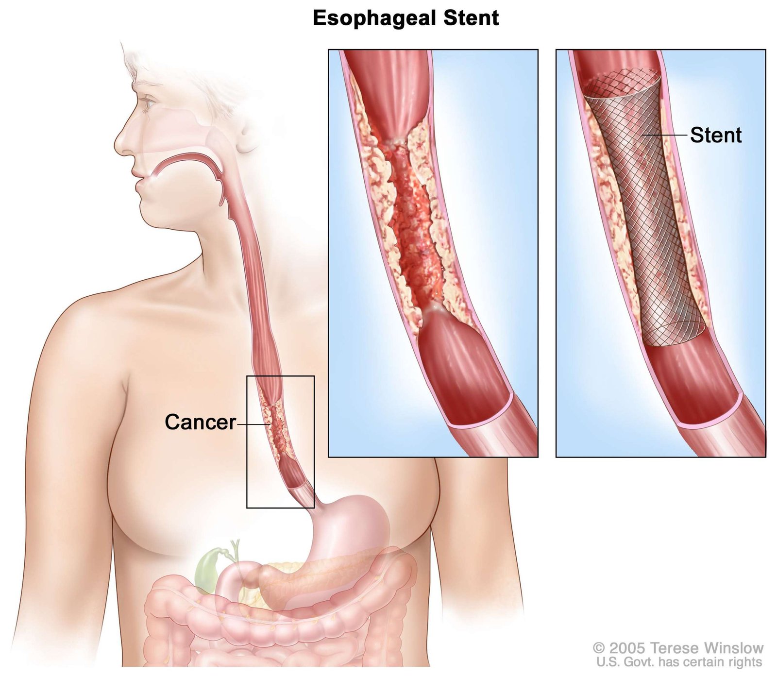 Oesophageal Cancer Surgeon in Dehradun – Expert Care by Dr. Sachin Arora
